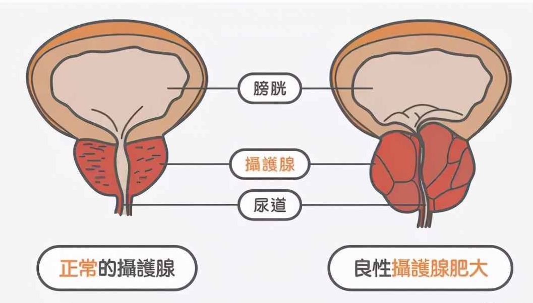 攝護腺肥大.png